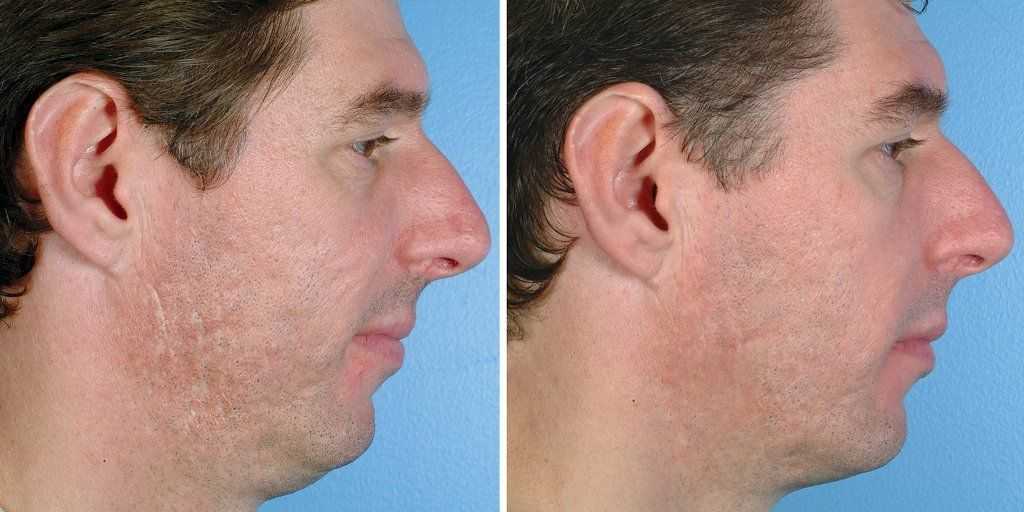 Алмазная дермабразия — преображение кожи лица